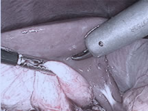 Colecistectomía por laparoscopia
