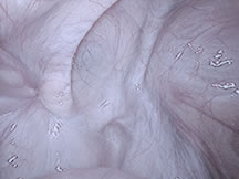 Hernia inguinal